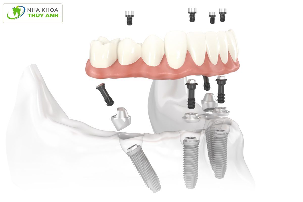 All on 6 dental implant, new technique to regenerate entire jaw