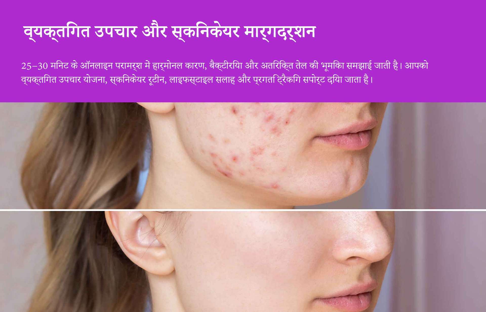 ऑनलाइन मुंहासों की परामर्श और उपचार