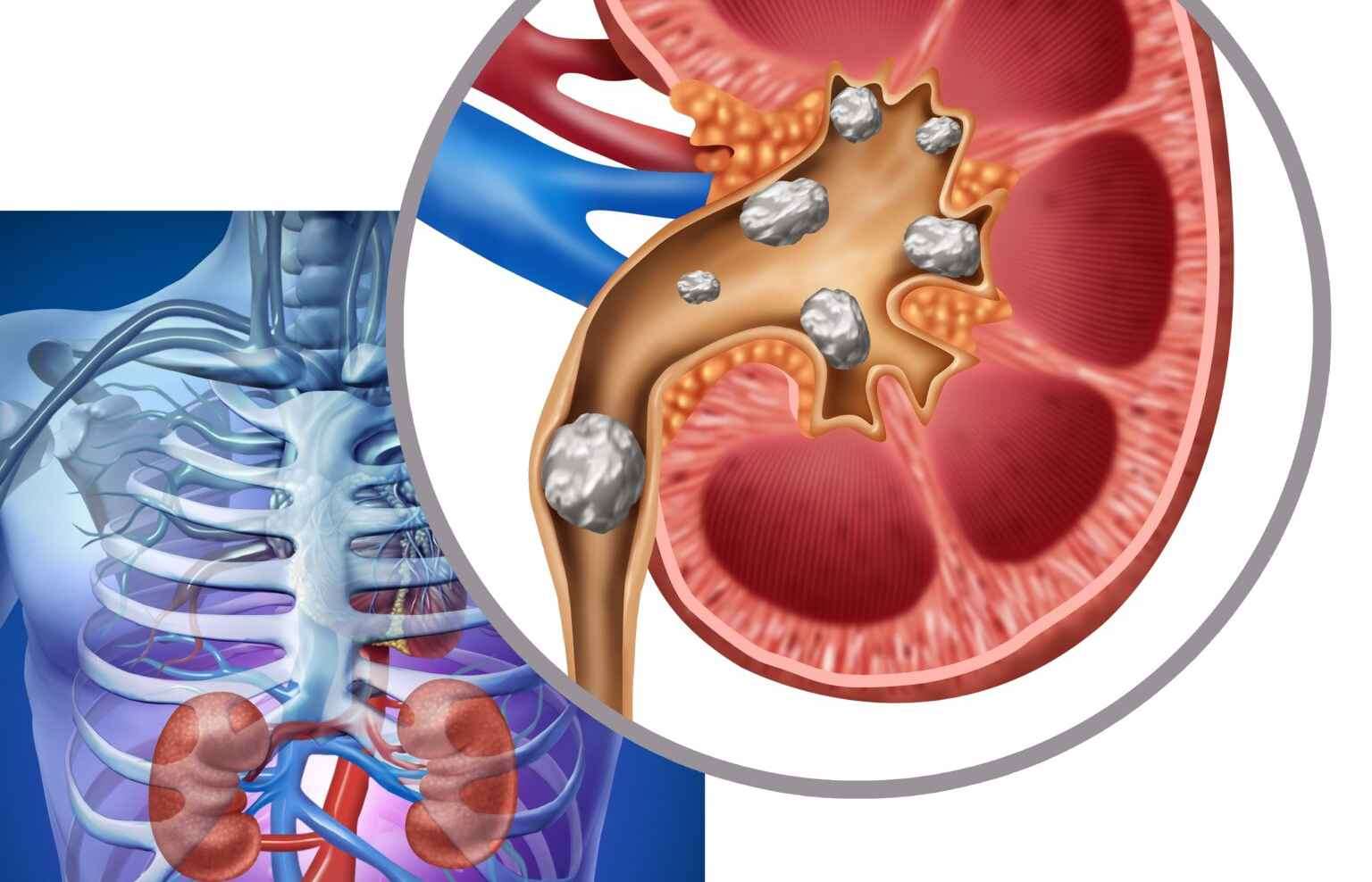 Expert Kidney Stone Treatment in Dallas–Fort Worth & Arlington, TX