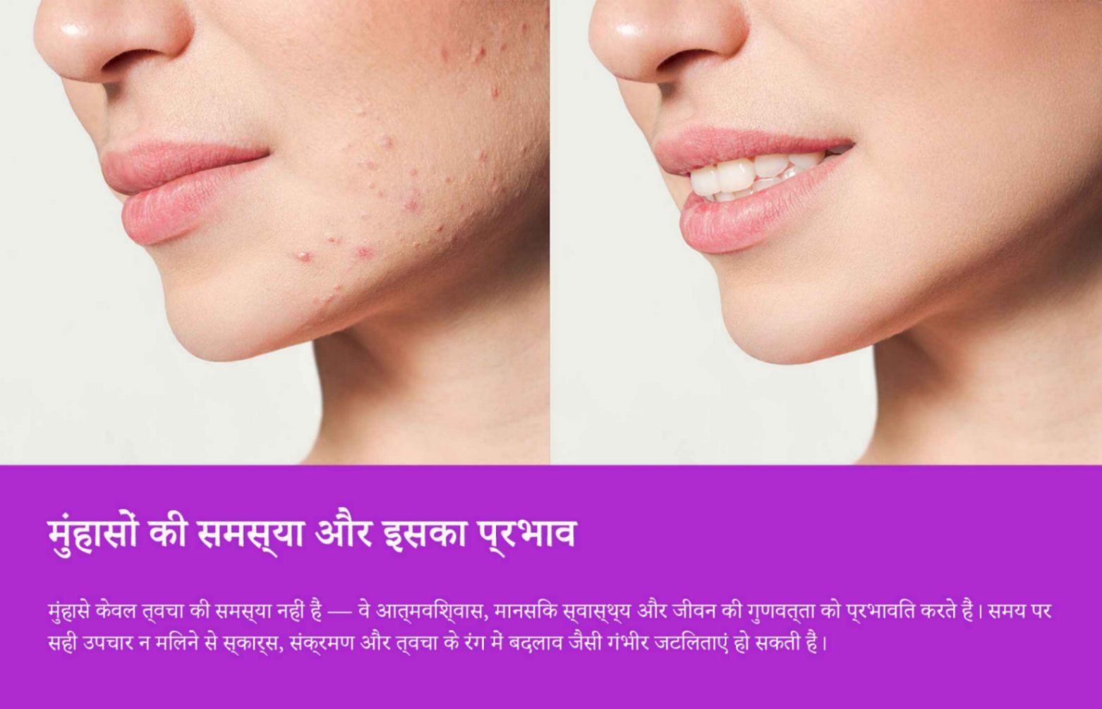 ऑनलाइन मुंहासों की परामर्श और उपचार