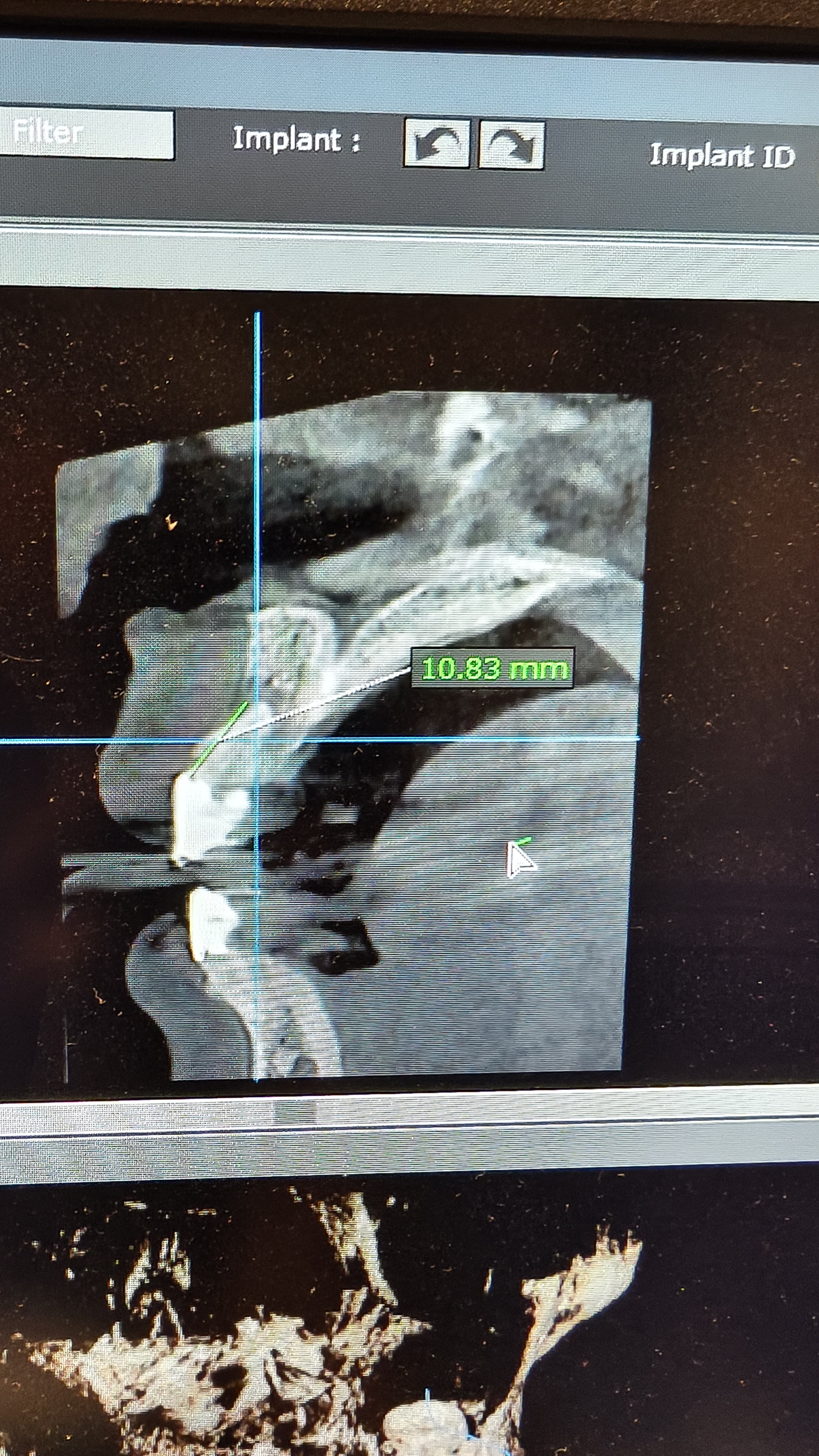 I will provide expert dental implant consultation and treatment planning