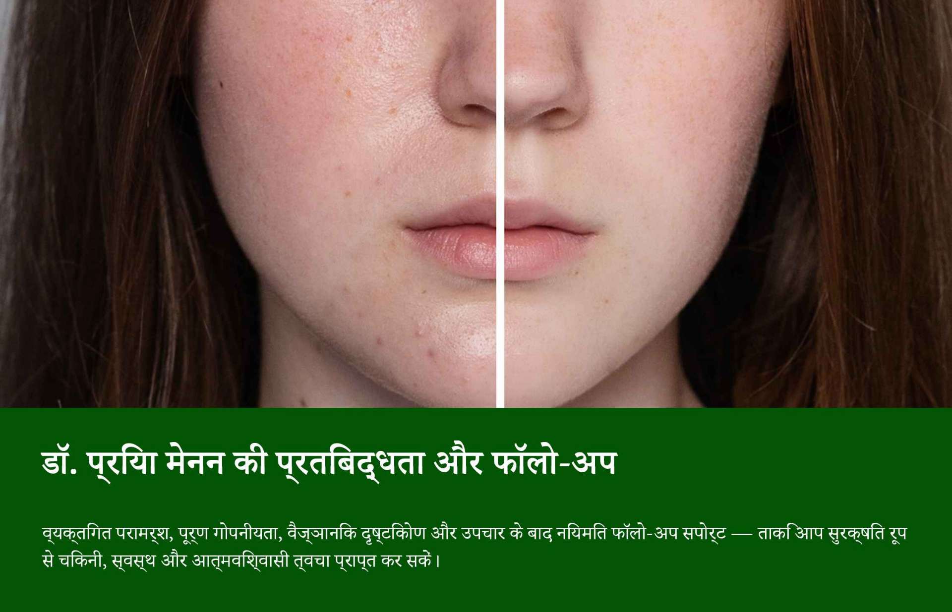 मुंहासे के निशानों का लेजर उपचार