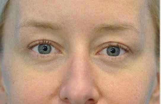 Upper Eyelid Blepharoplasty Surgery