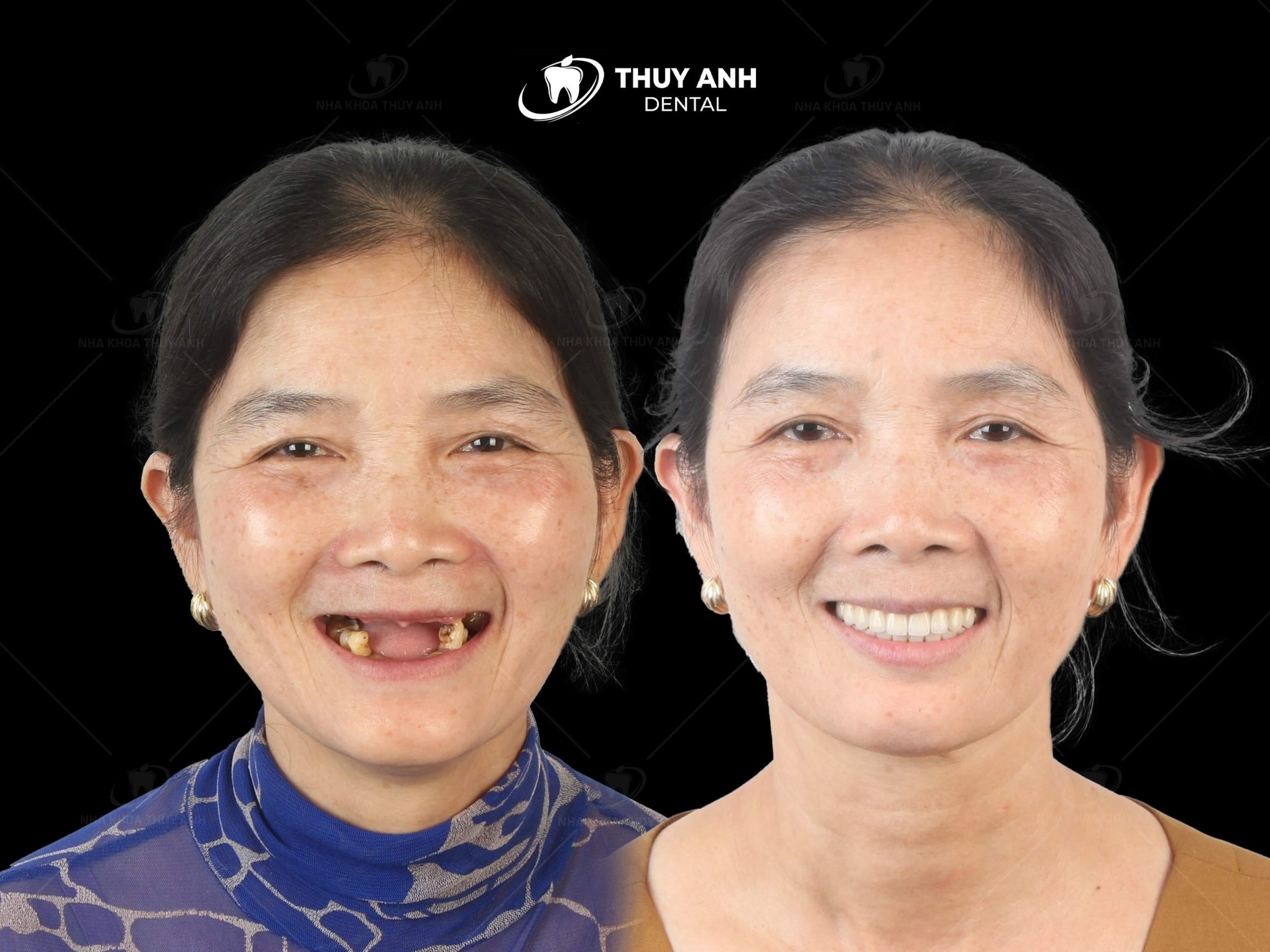 All on 6 dental implant, new technique to regenerate entire jaw