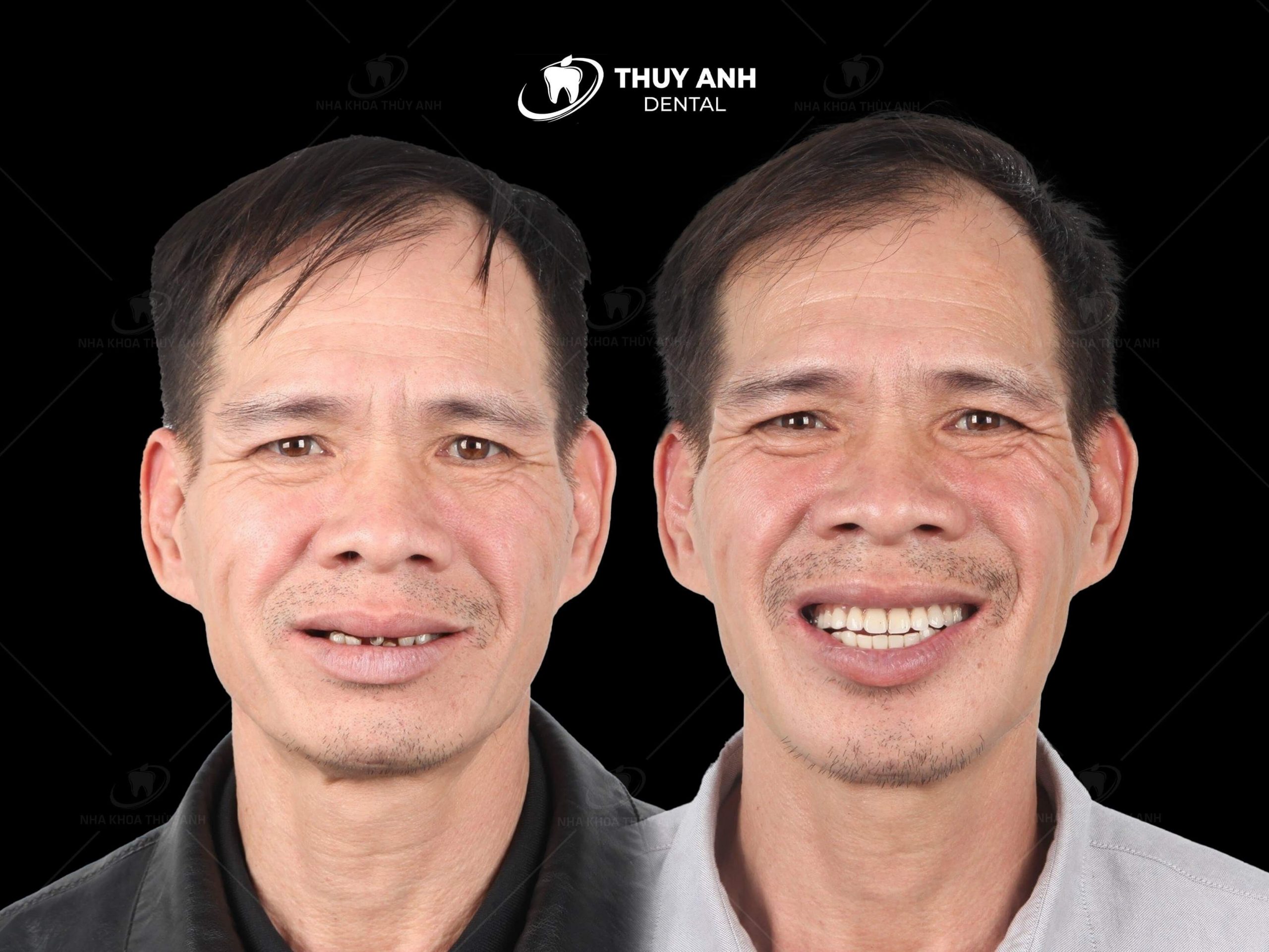 All on 6 dental implant, new technique to regenerate entire jaw