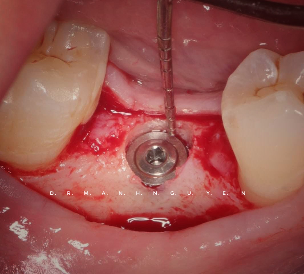 Cấy ghép Implant