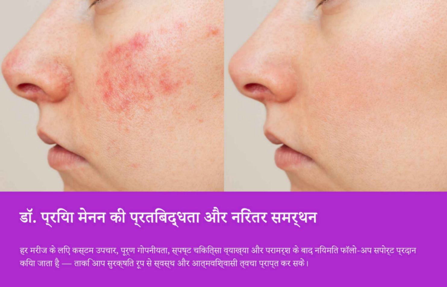 ऑनलाइन मुंहासों की परामर्श और उपचार