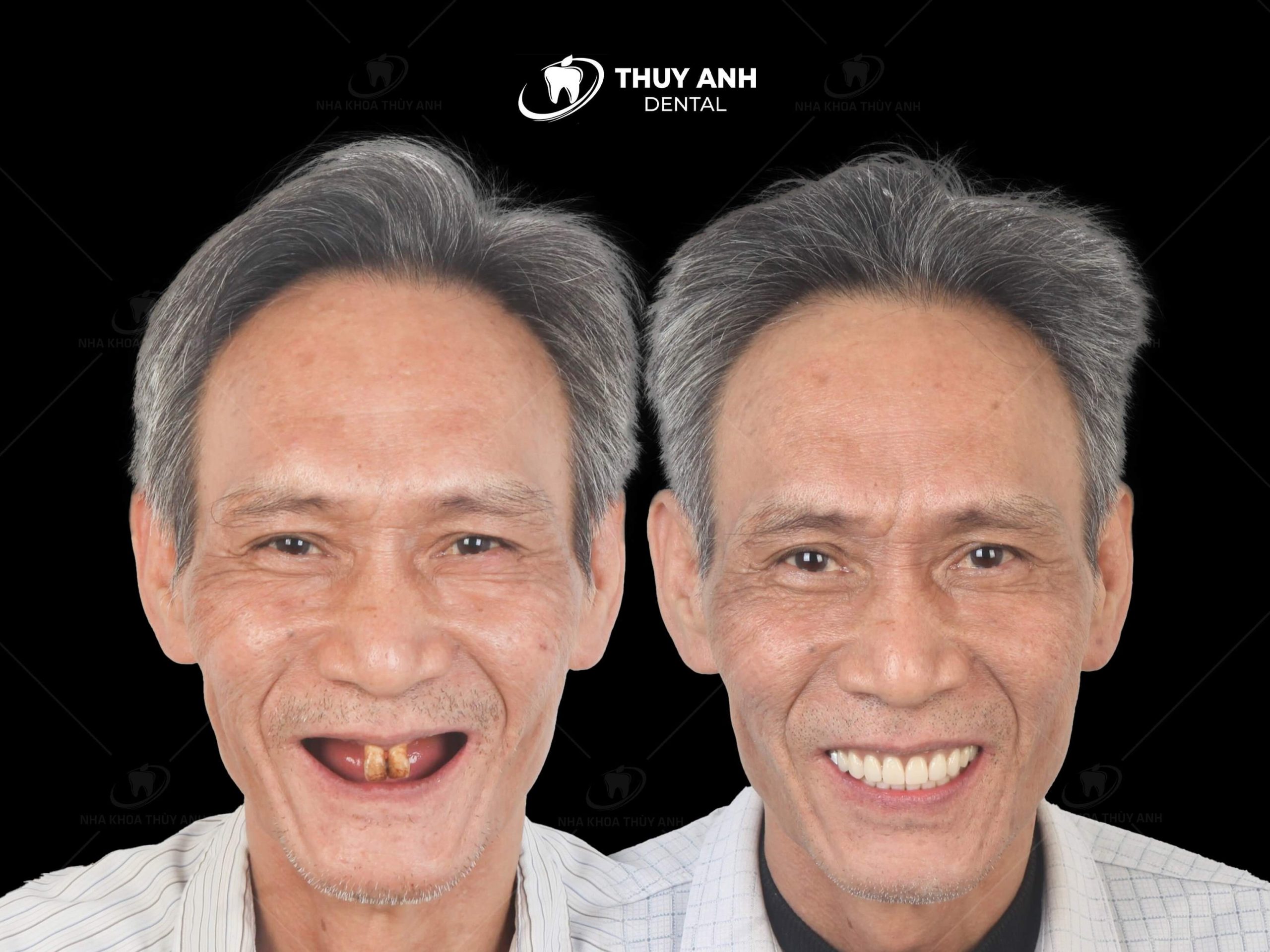 All on 6 dental implant, new technique to regenerate entire jaw