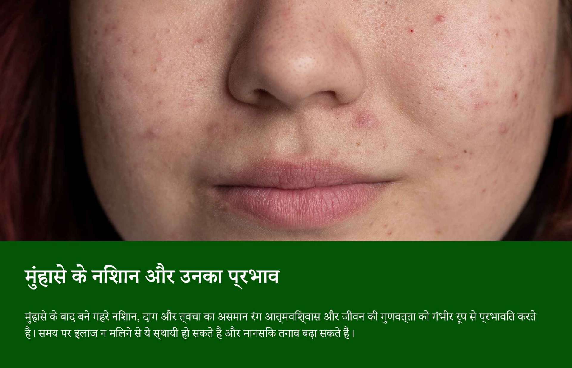 मुंहासे के निशानों का लेजर उपचार