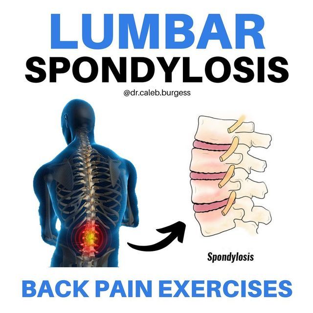 Low back pain exercises- lumbar spondylosis