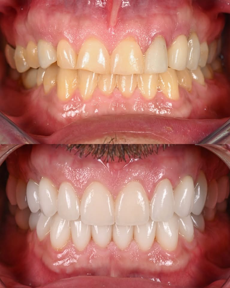 Nha sĩ không chỉ điều trị các bệnh lý răng miệng mà còn lắng nghe nhu cầu của khách hàng, tư vấn phương án điều trị phù hợp, giải thích rõ quy trình và chi phí, giúp giảm đau, giảm lo lắng trong quá trình điều trị. Đồng thời, nha sĩ hướng dẫn cách chăm sóc răng miệng đúng cách và theo dõi sau điều trị để đảm bảo kết quả lâu dài, giúp khách hàng có sức khỏe răng miệng tốt và nụ cười tự tin.”
