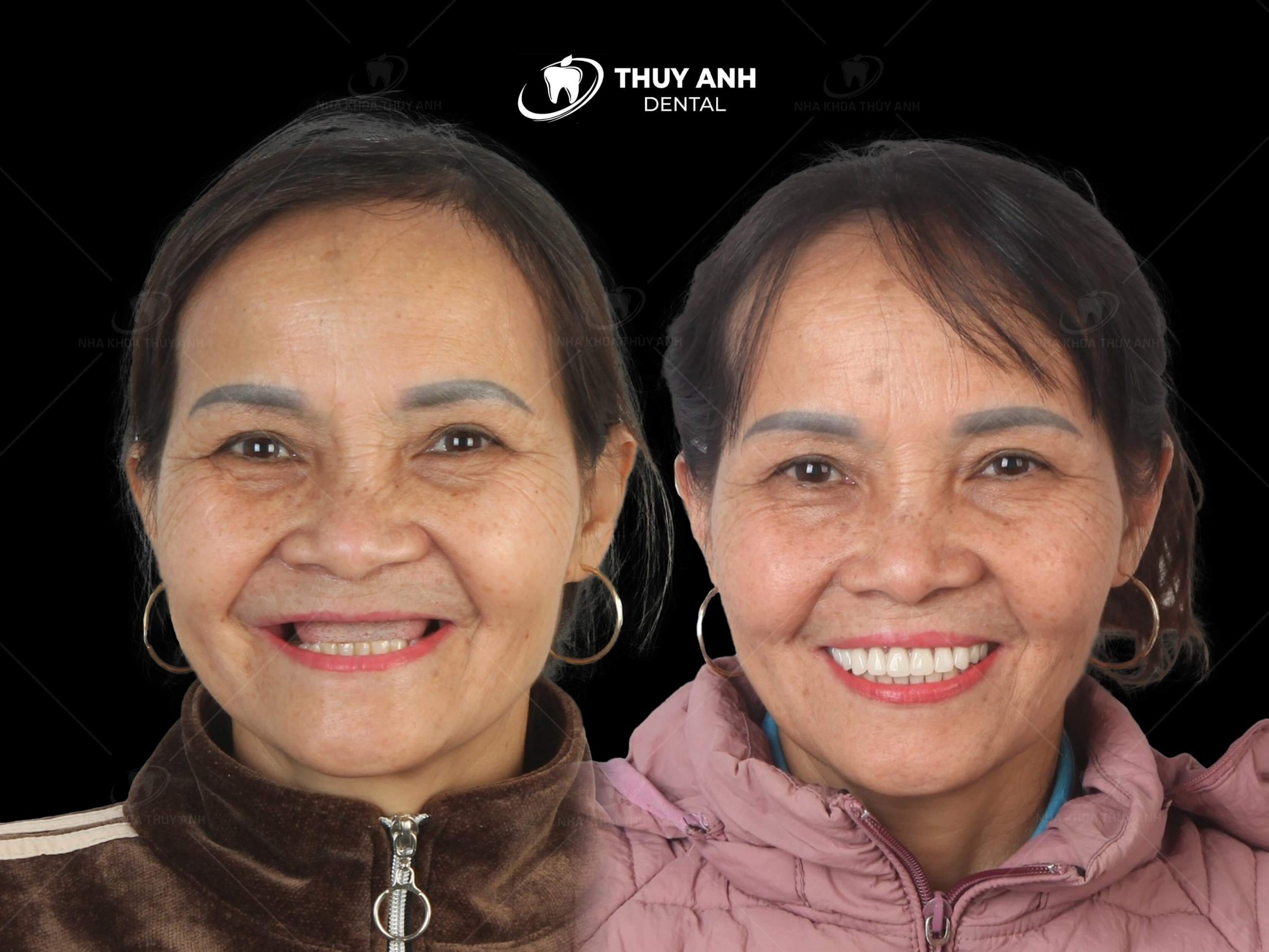 All on 6 dental implant, new technique to regenerate entire jaw
