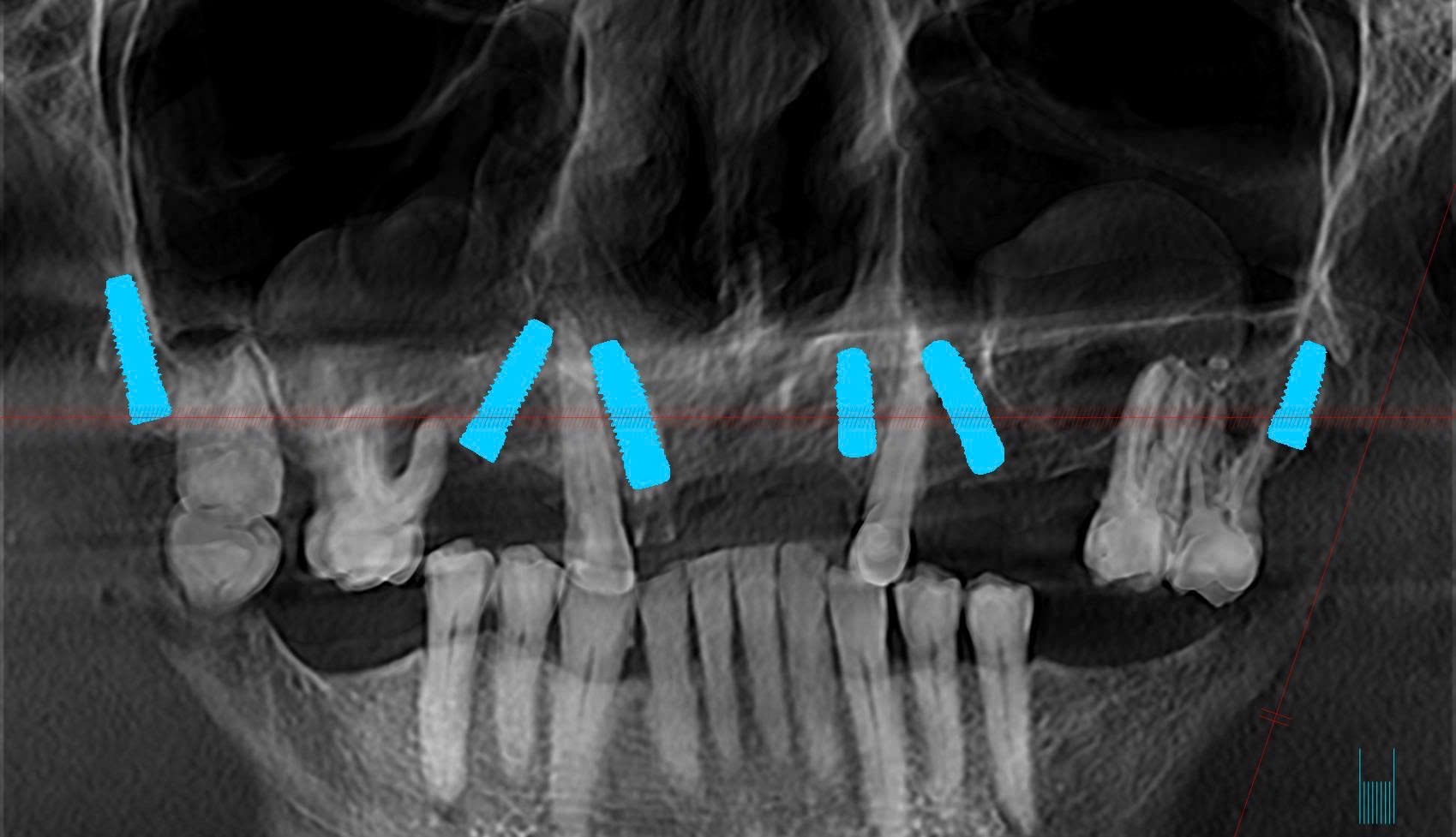 Tôi là bác sĩ răng hàm mặt/ hỗ trợ tư vấn điều trị nha khoa implant trồng răng sứ tại Nha Trang